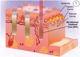 tratament articular co2