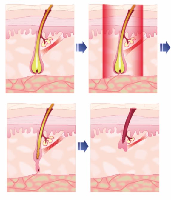 Epilare definitiva laser