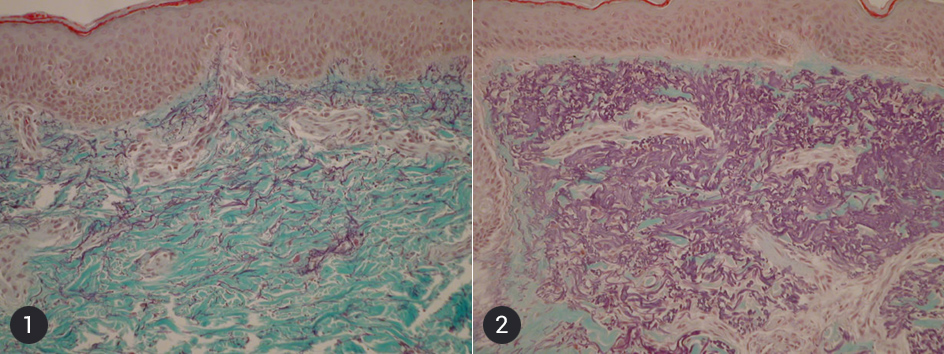 Rezultate tratament microace