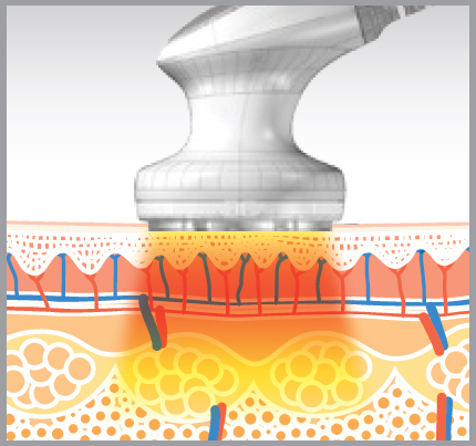 Low Level Laser Therapy