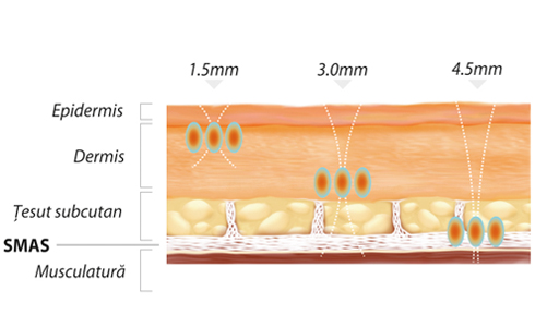 Ultrasunetele focusate sunt livrate în straturile pielii la diferite adâncimi