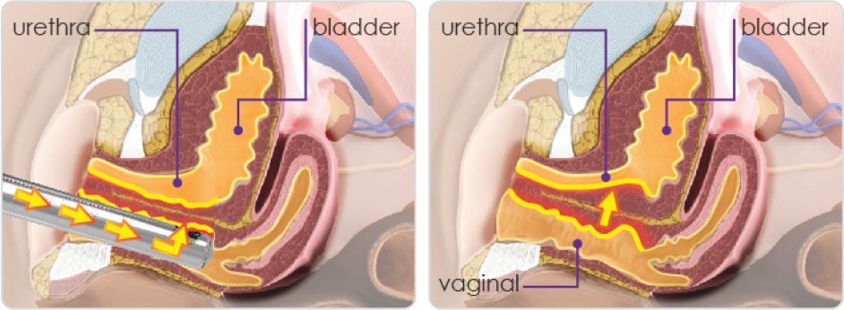 Tratament incontinenta urinara (IUE)