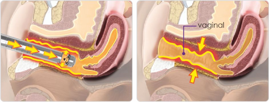 Tratament rejuvenare vaginala